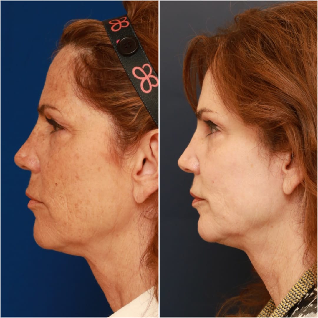 Brow Lift Before & After Gallery - Patient 58233162 - Image 3