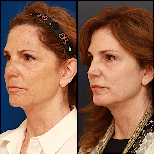 Brow Lift Before & After Gallery - Patient 58233162 - Image 4