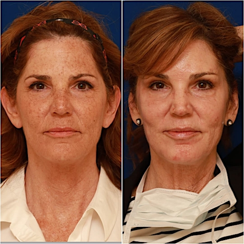 Otoplasty Before & After Gallery - Patient 58233196 - Image 1