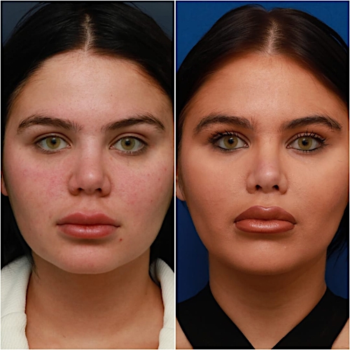 Lip Lift Before & After Gallery - Patient 58233166 - Image 1