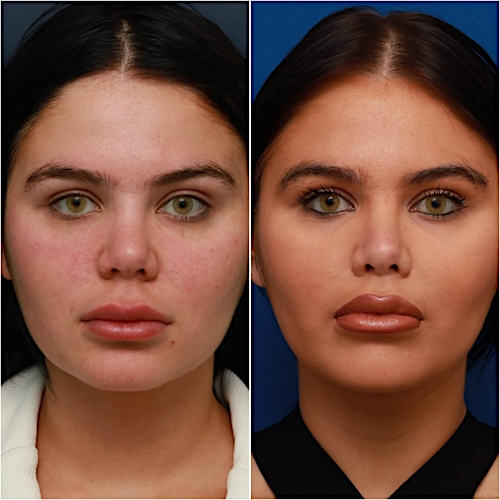 Lip Lift Before & After Gallery - Patient 58233166 - Image 1