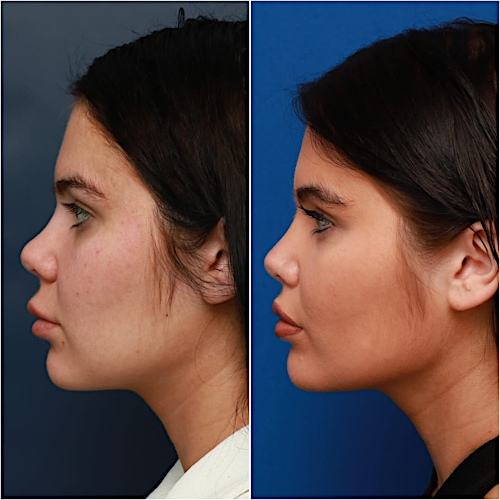 Lip Lift Before & After Gallery - Patient 58233166 - Image 3