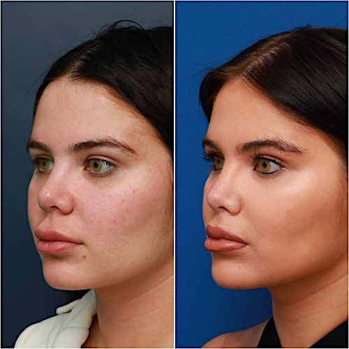 Lip Lift Before & After Gallery - Patient 58233166 - Image 4