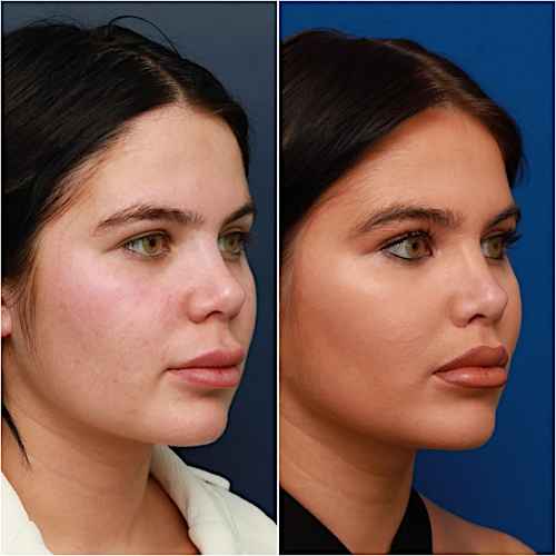 Lip Lift Before & After Gallery - Patient 58233166 - Image 5