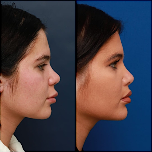 Lip Lift Before & After Gallery - Patient 58233166 - Image 6