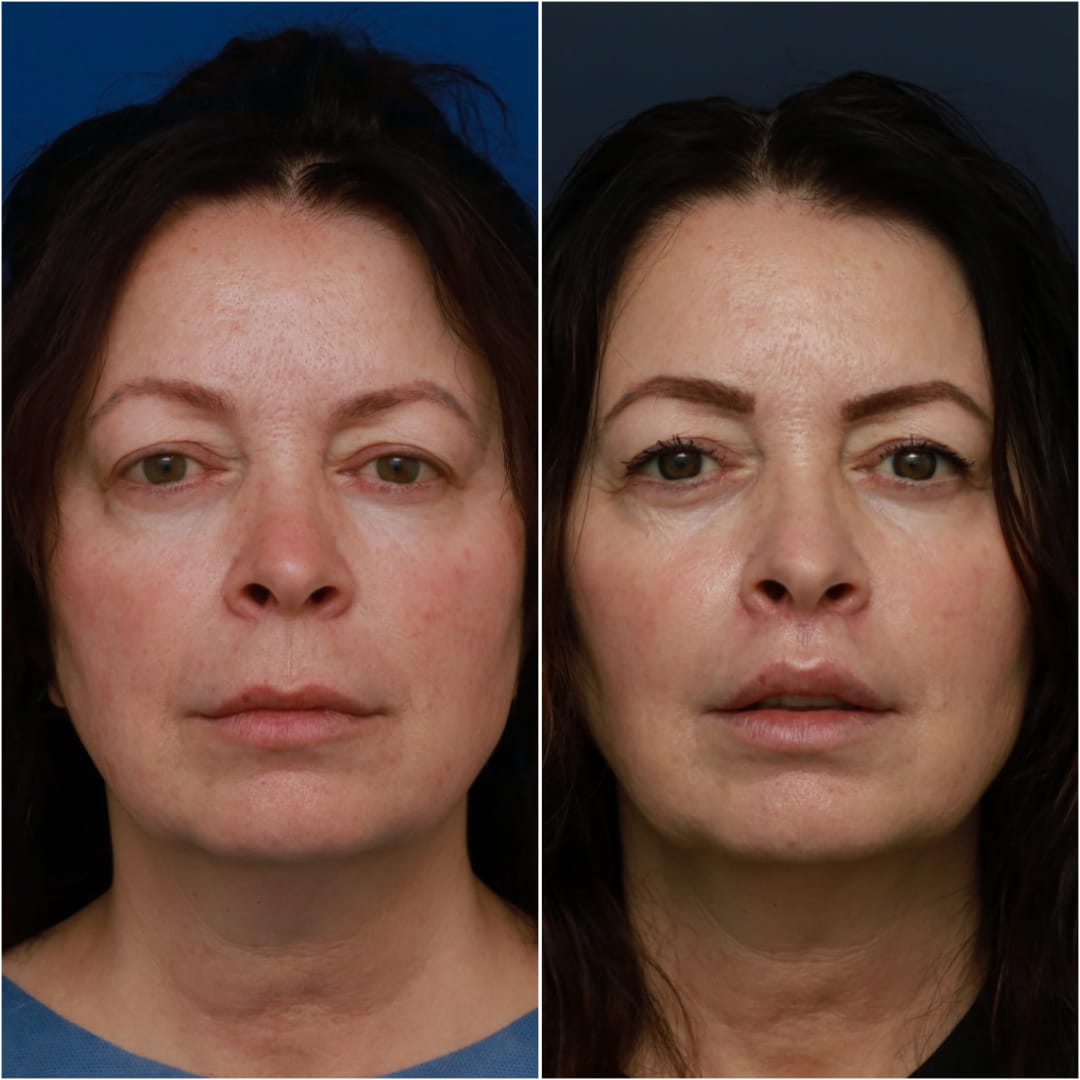 Lip Lift Before & After Gallery - Patient 58233167 - Image 1