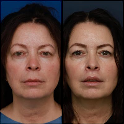 Lip Lift Before & After Gallery - Patient 58233167 - Image 1