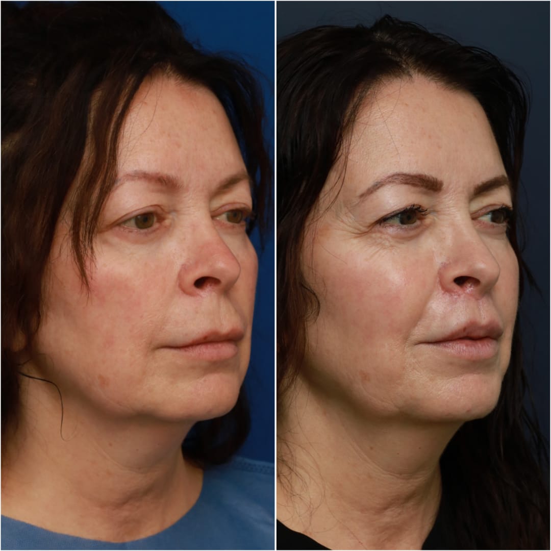 Lip Lift Before & After Gallery - Patient 58233167 - Image 2