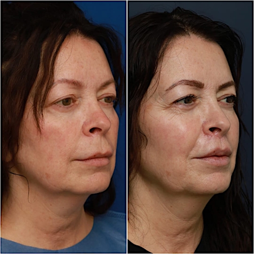 Lip Lift Before & After Gallery - Patient 58233167 - Image 2