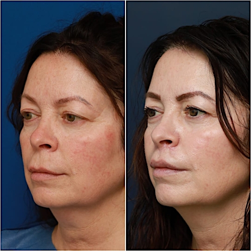 Lip Lift Before & After Gallery - Patient 58233167 - Image 3