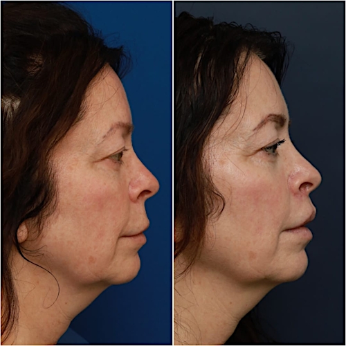 Lip Lift Before & After Gallery - Patient 58233167 - Image 4