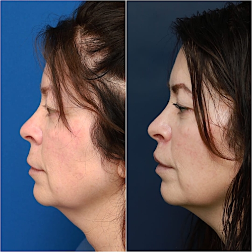 Lip Lift Before & After Gallery - Patient 58233167 - Image 5