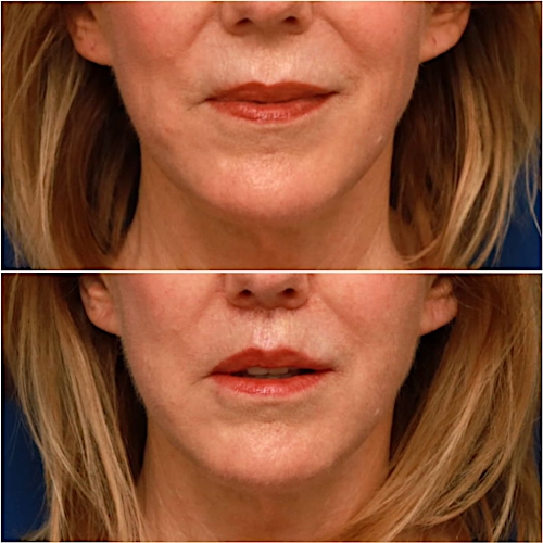 Lip Lift Before & After Gallery - Patient 58233168 - Image 1