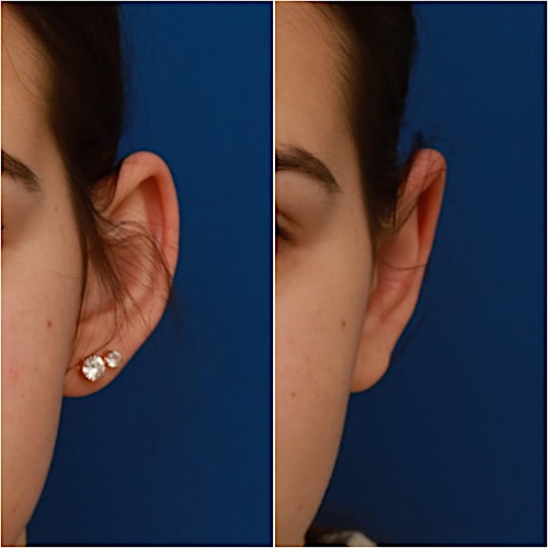 Otoplasty Before & After Gallery - Patient 58233180 - Image 1
