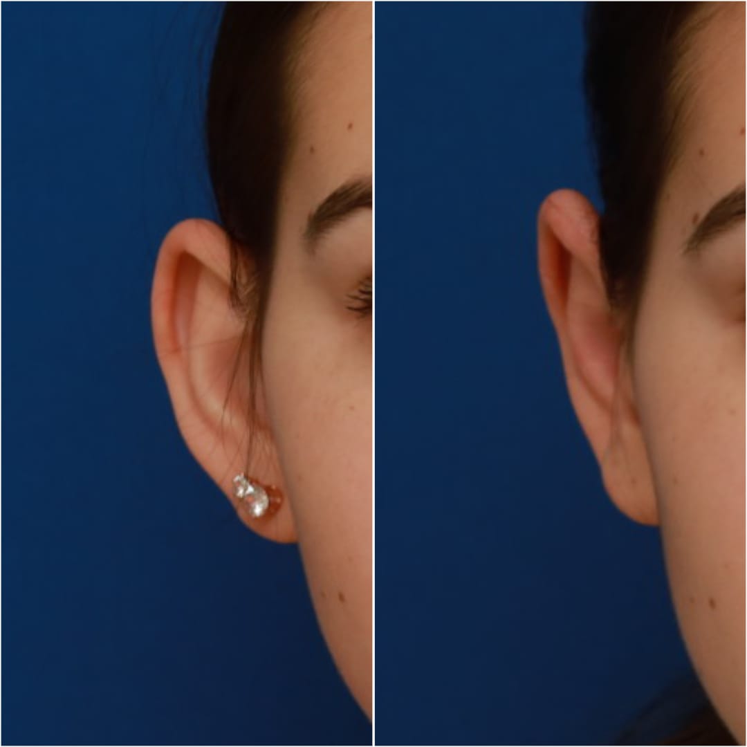 Otoplasty Before & After Gallery - Patient 58233180 - Image 2