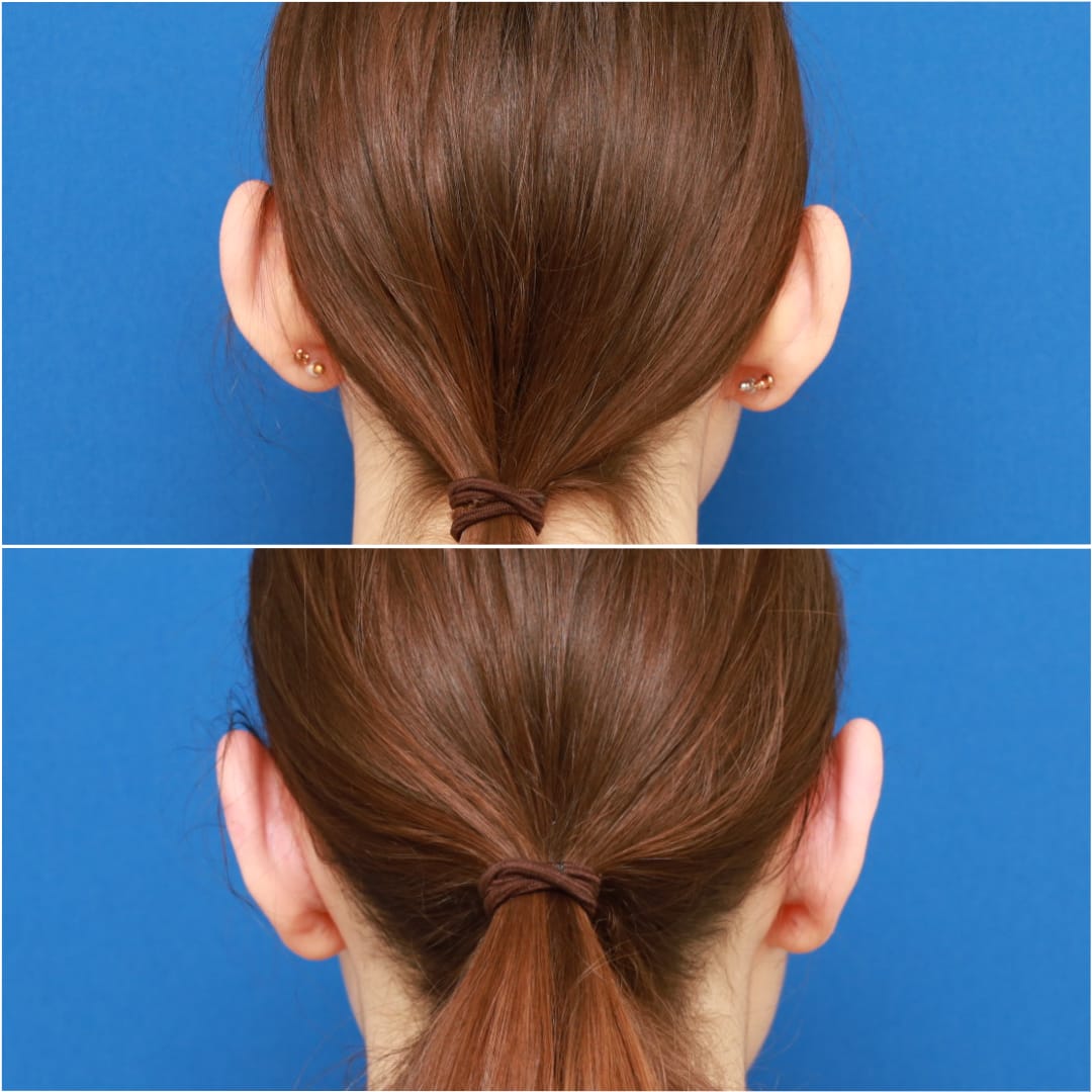 Otoplasty Before & After Gallery - Patient 58233180 - Image 3