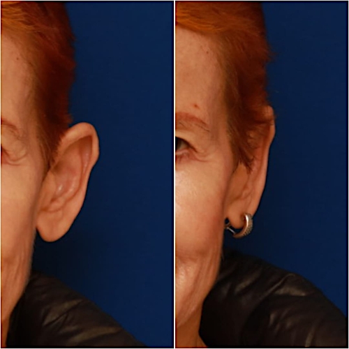 Otoplasty Before & After Gallery - Patient 58233181 - Image 1