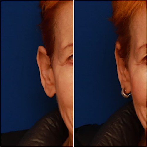 Otoplasty Before & After Gallery - Patient 58233181 - Image 2
