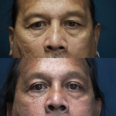 Blepharoplasty Before & After Gallery - Patient 58233199 - Image 1