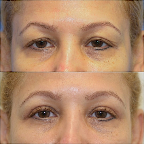 Blepharoplasty Before & After Gallery - Patient 58233200 - Image 1