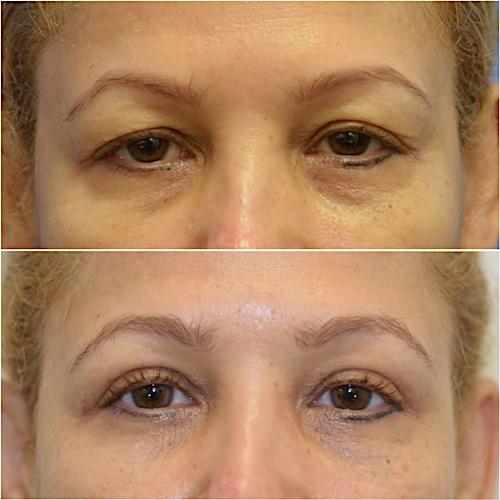 Blepharoplasty Before & After Gallery - Patient 58233200 - Image 2
