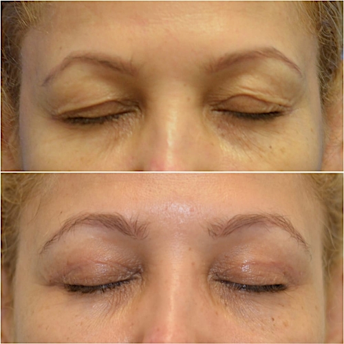 Blepharoplasty Before & After Gallery - Patient 58233200 - Image 3