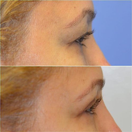 Blepharoplasty Before & After Gallery - Patient 58233200 - Image 4
