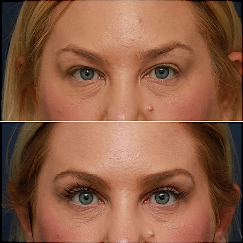Blepharoplasty Before & After Gallery - Patient 58233204 - Image 1