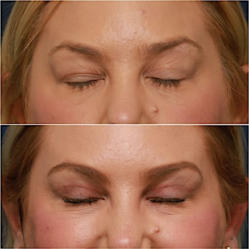 Blepharoplasty Before & After Gallery - Patient 58233204 - Image 2