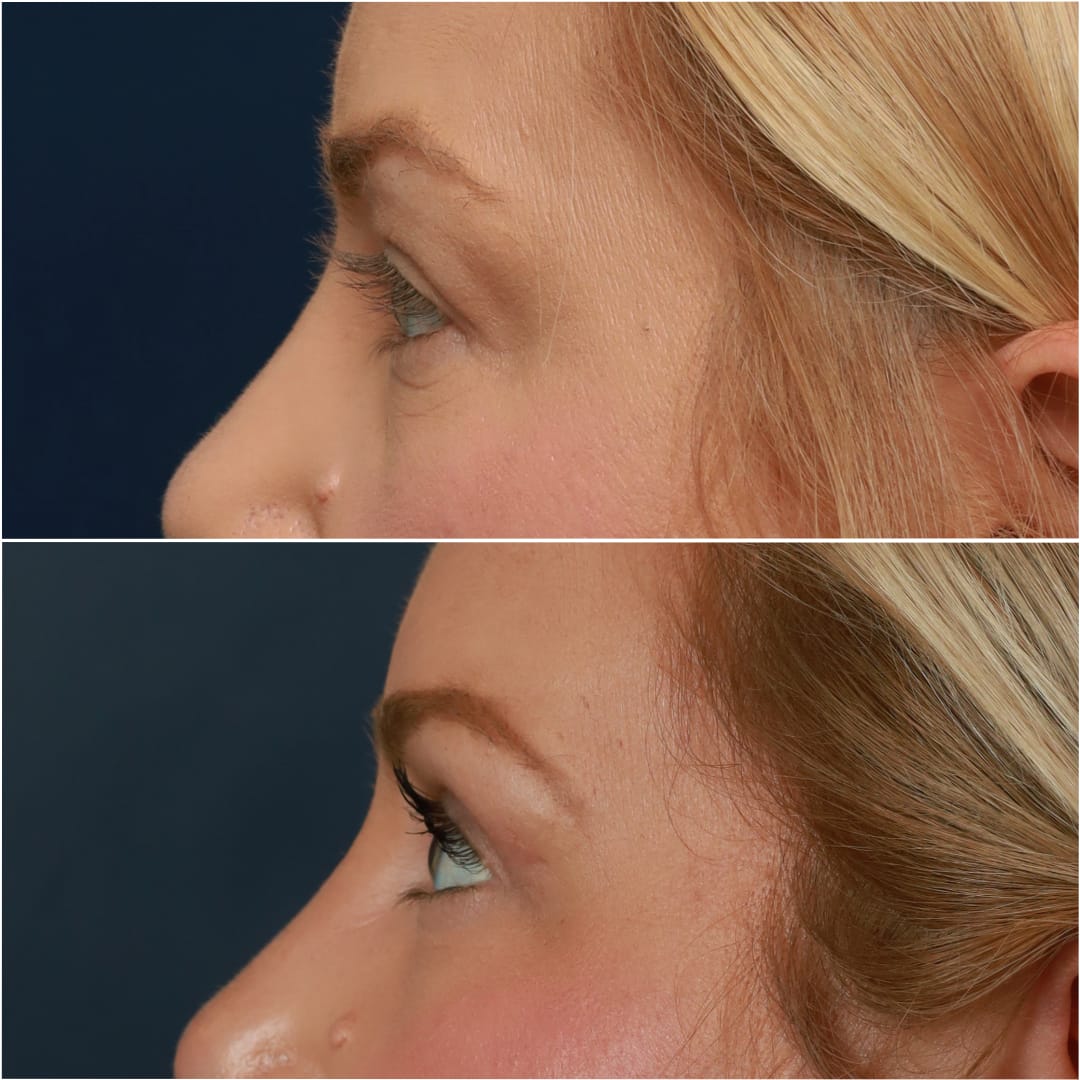 Blepharoplasty Before & After Gallery - Patient 58233204 - Image 3