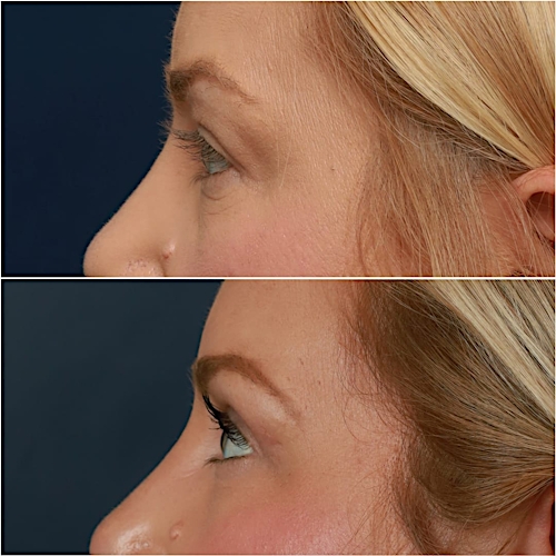 Blepharoplasty Before & After Gallery - Patient 58233204 - Image 3