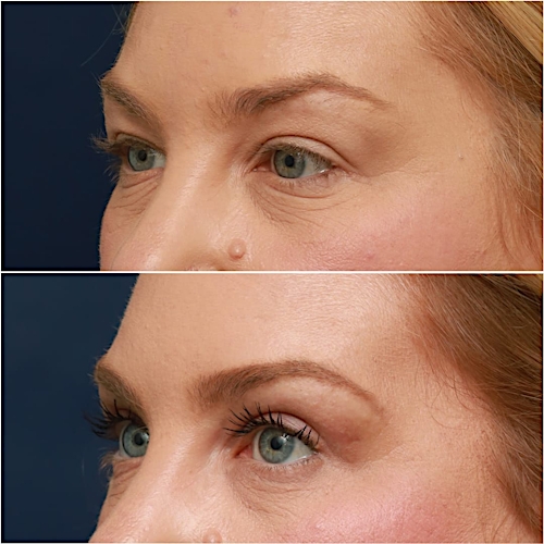 Blepharoplasty Before & After Gallery - Patient 58233204 - Image 4