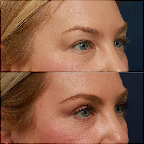 Blepharoplasty Before & After Gallery - Patient 58233204 - Image 5