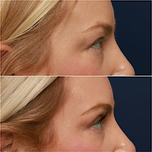 Blepharoplasty Before & After Gallery - Patient 58233204 - Image 6