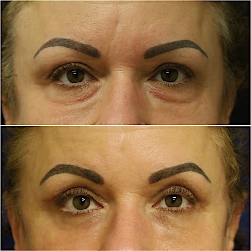 Blepharoplasty Before & After Gallery - Patient 58233205 - Image 1