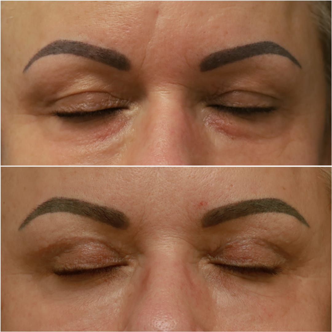 Blepharoplasty Before & After Gallery - Patient 58233205 - Image 2