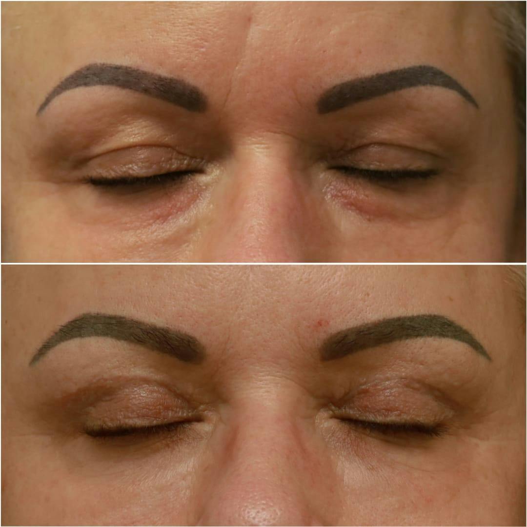 Blepharoplasty Before & After Gallery - Patient 58233205 - Image 2