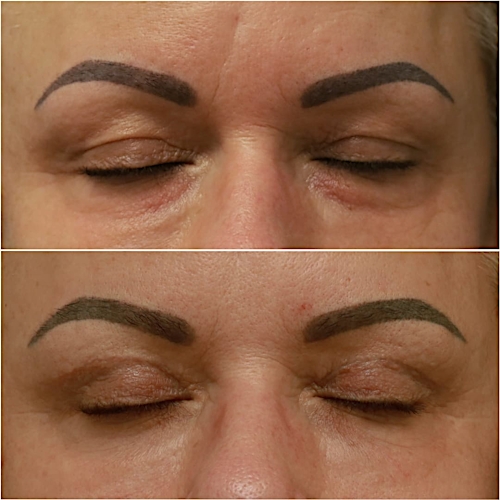 Blepharoplasty Before & After Gallery - Patient 58233205 - Image 2