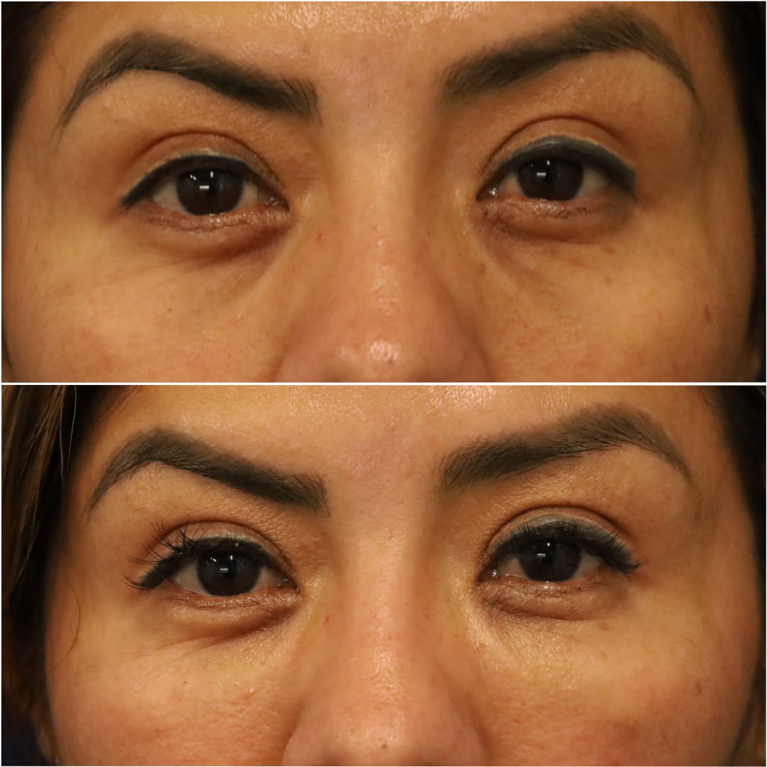 Undereye Rejuvenation/Tear Troughs Before & After Gallery - Patient 58233212 - Image 1
