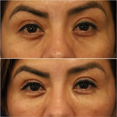 Undereye Rejuvenation Before & After Gallery - Patient 58233212 - Image 1