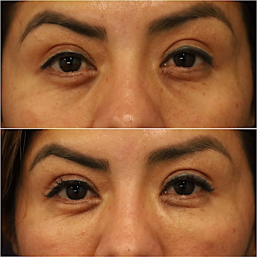 Undereye Rejuvenation Before & After Gallery - Patient 58233212 - Image 1