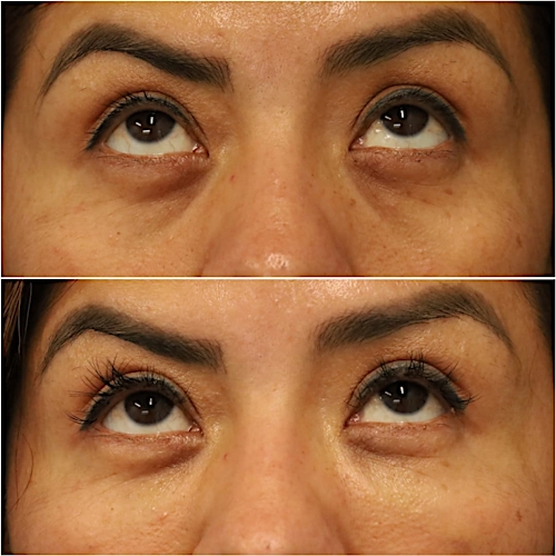 Undereye Rejuvenation Before & After Gallery - Patient 58233212 - Image 2