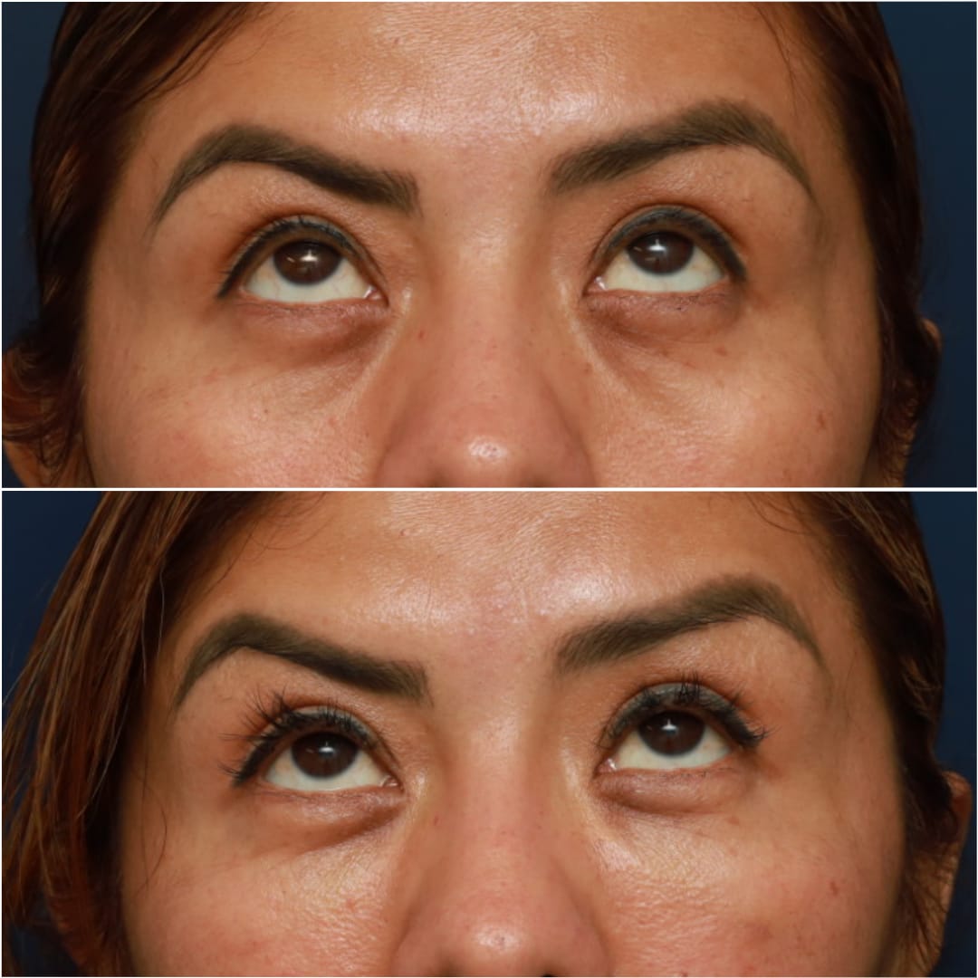 Undereye Rejuvenation/Tear Troughs Before & After Gallery - Patient 58233212 - Image 3