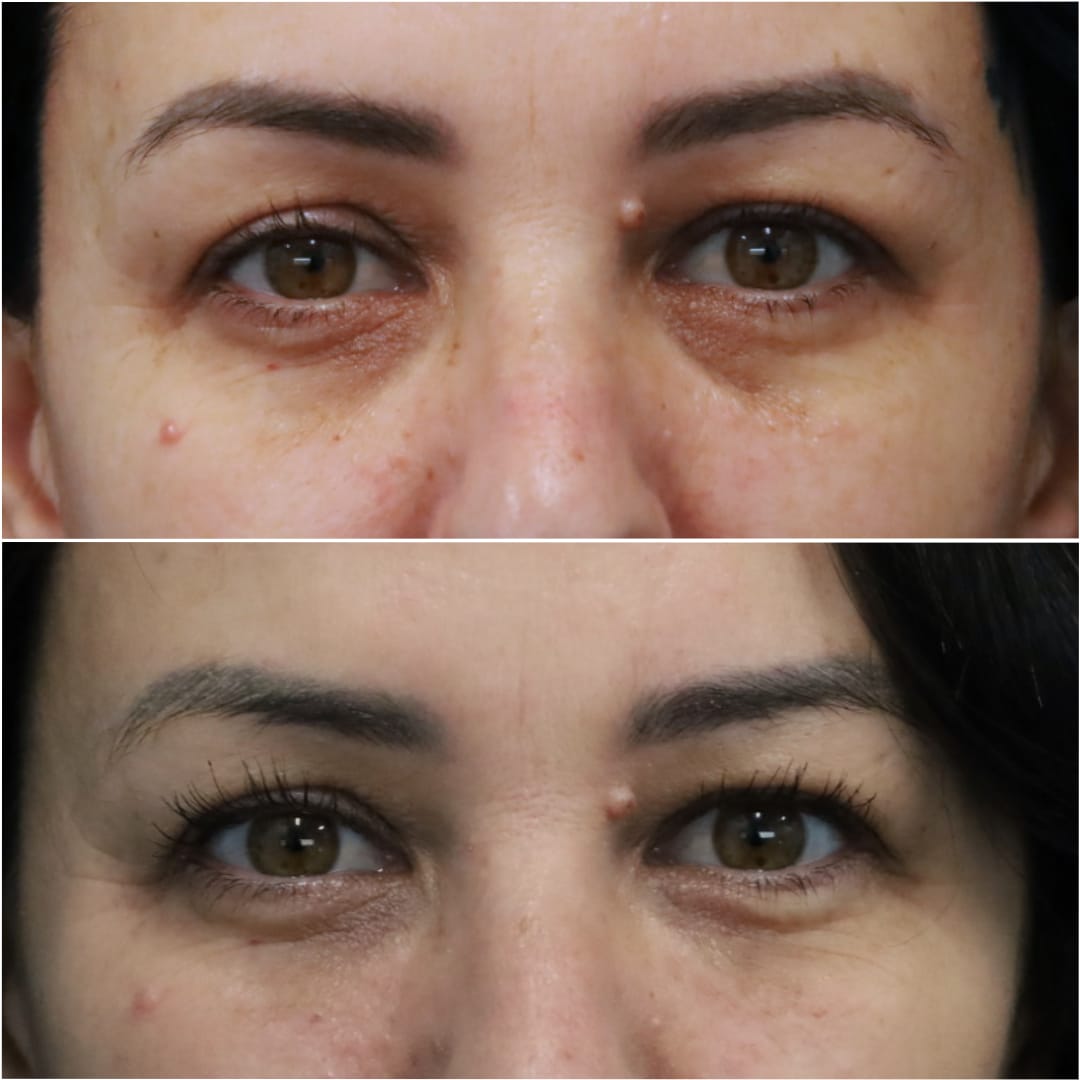 Undereye Rejuvenation/Tear Troughs Before & After Gallery - Patient 58233213 - Image 1