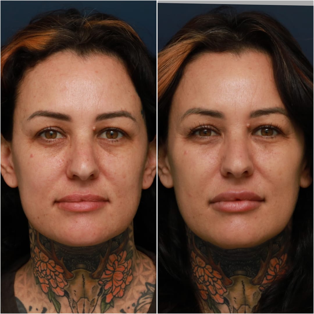 Undereye Rejuvenation/Tear Troughs Before & After Gallery - Patient 58233213 - Image 2