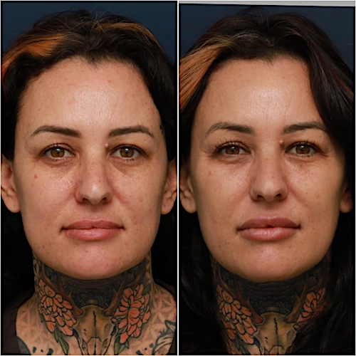 Undereye Rejuvenation Before & After Gallery - Patient 58233213 - Image 2