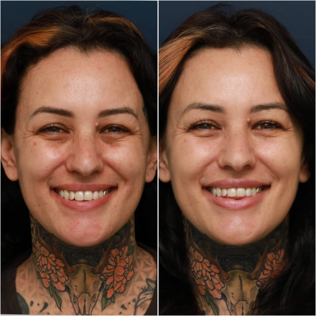 Undereye Rejuvenation/Tear Troughs Before & After Gallery - Patient 58233213 - Image 3