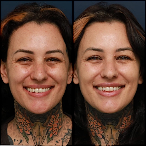Undereye Rejuvenation Before & After Gallery - Patient 58233213 - Image 3