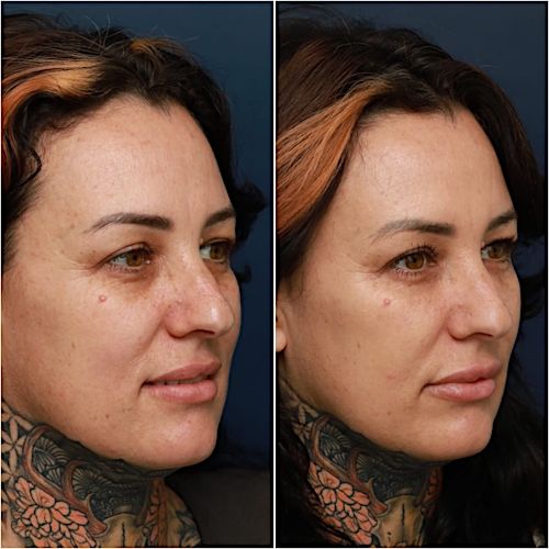 Undereye Rejuvenation Before & After Gallery - Patient 58233213 - Image 4