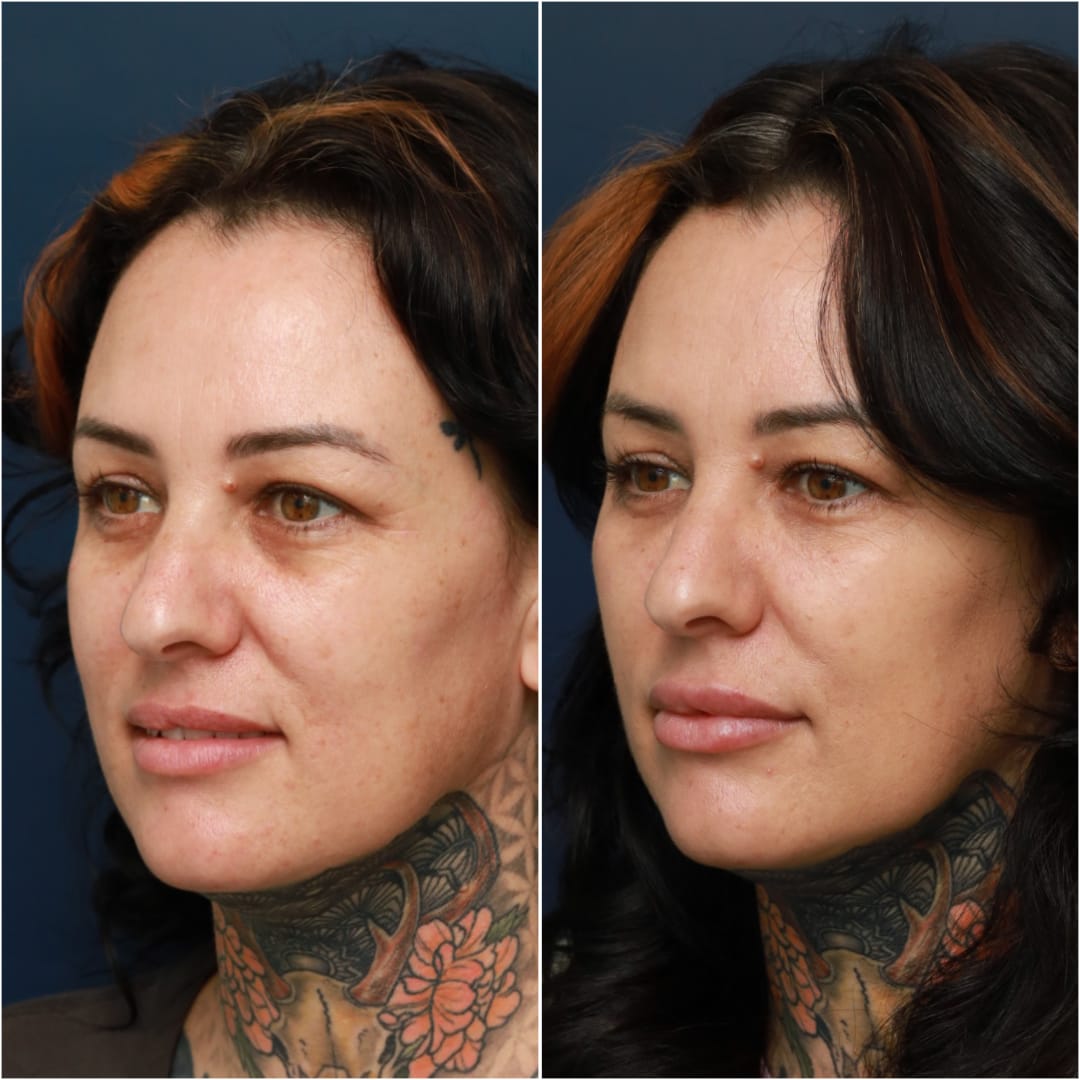 Undereye Rejuvenation/Tear Troughs Before & After Gallery - Patient 58233213 - Image 5